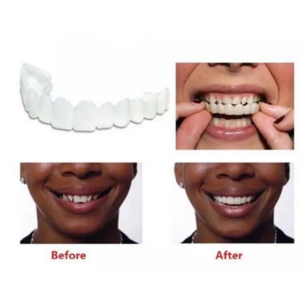 Dentier Esthétique Amovible